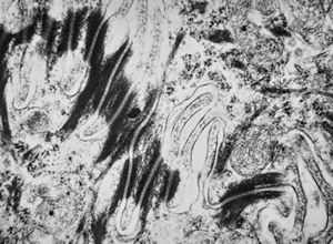 F,31y. | mucoepidermoid carcinoma